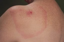 teek erythema migrans huidziekten.nl